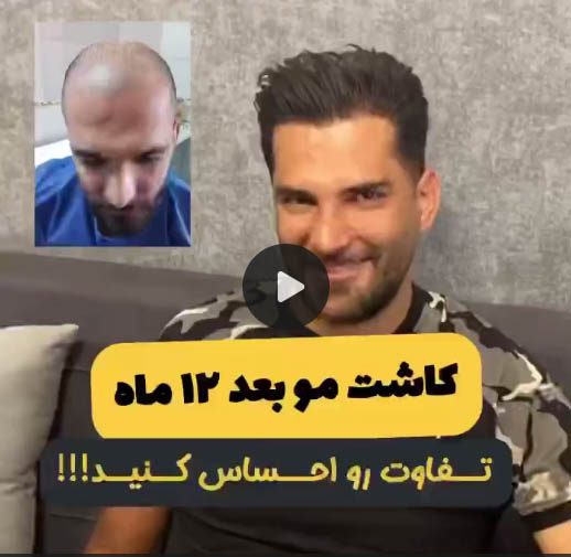 نتایج کاشت مو 1