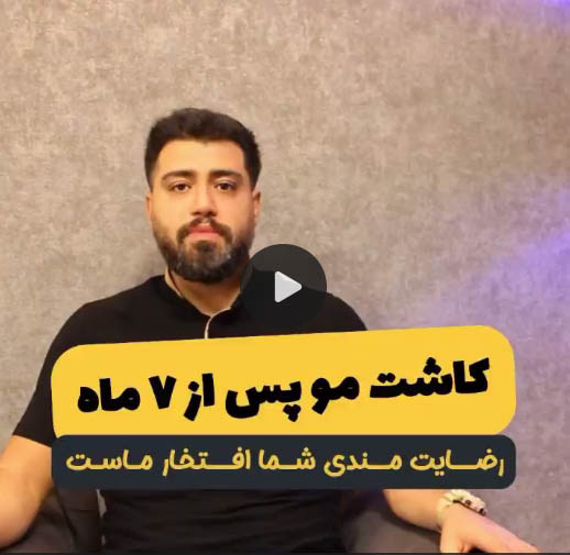 نتایج کاشت مو 2