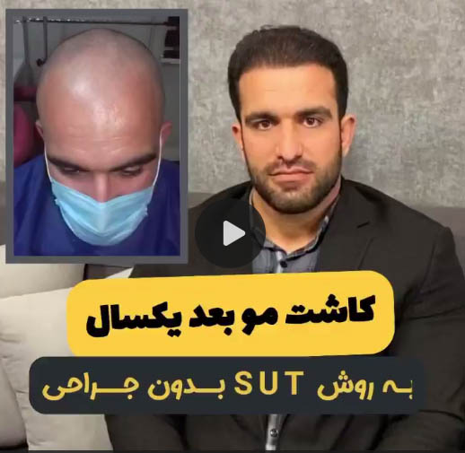 نتایج کاشت مو 3