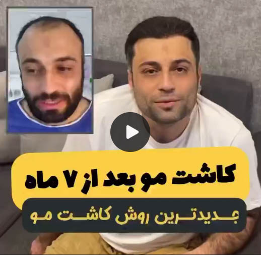 نتایج کاشت مو 4