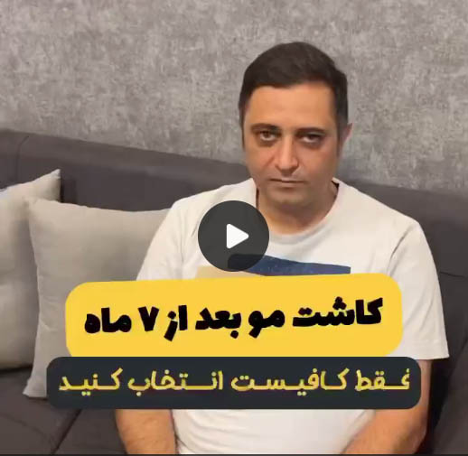 نتایج کاشت مو 5