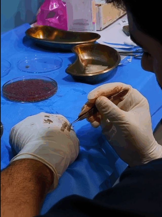 کاشت مو خیلی راحته !